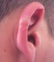 ear rash #9
