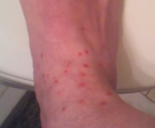 How long can a rash caused by chiggers last?