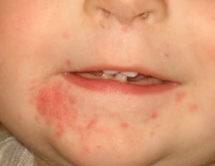 Pictures Of Babies Face Rash 28