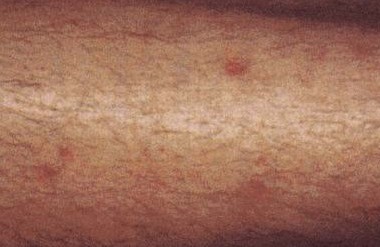 Itchy Skin on Lower Legs: Causes and Remedies | Just ...