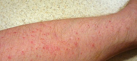 Red Rash On Lower Right Leg Symptoms - HealthTap