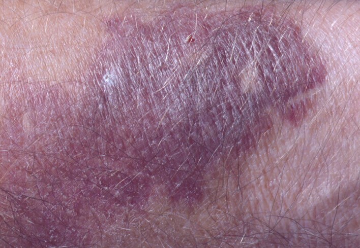 actinic purpura - Dermatology - MedHelp