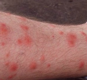 I have red itchy spots - Dermatology - MedHelp