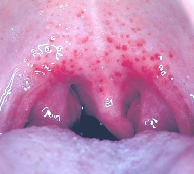 Pictures Of Red Spots On Palate 13