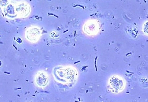 White Blood Cells In Urine No Infection Causes