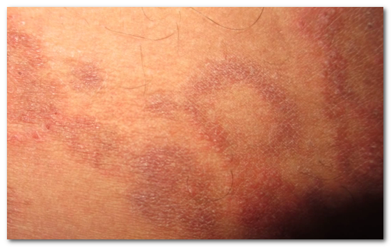 Rash On Inner Thigh Healthy Life Med