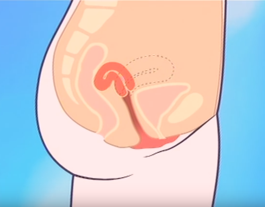 Retroverted Uterus Sex 103