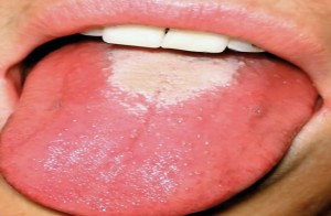 bumps on back of tongue pictures