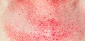 Dermatomyositis rash images