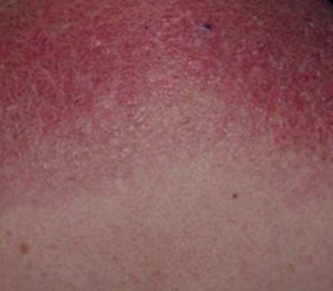 Dermatomyositis rash photos