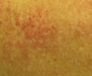 Dermatomyositis rash pictures 2