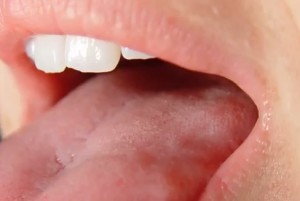 bump on roof of mouth