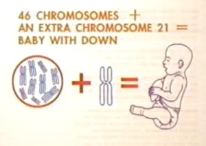 down syndrome chromosome images