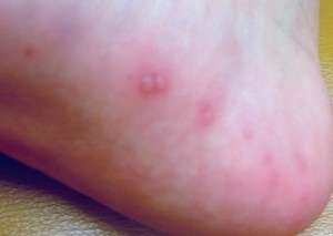 hand foot mouth rash picture