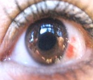 herpes of the eye images