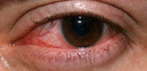 herpes of the eye photos