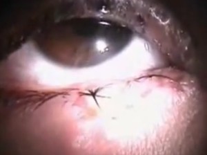 herpes of the eye pictures