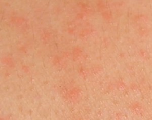 hiv skin rash