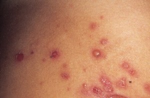 indian fire rash pictures