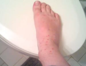 chiggers rash pictures
