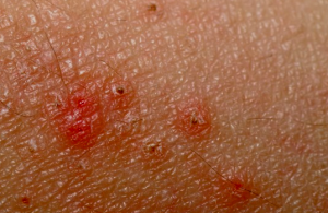 strawberry allergy rash pictures