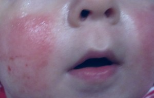teething rash face