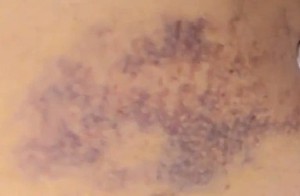 Ecchymosis pictures 2