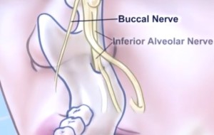 Inferior Alveolar Nerve