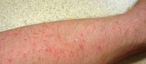 Itchy Red bumps on legs