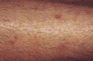 Itchy Red bumps on legs pictures