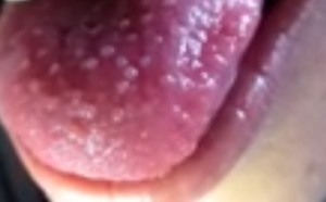enlarged papillae pictures 2