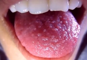 enlarged papillae tongue