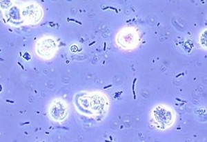 white blood cells in urine images