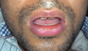 Exfoliative Cheilitis lips images