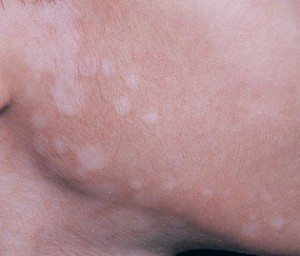 Pityriasis Alba face pictures