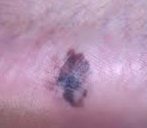 acral lentiginous melanoma pictures 2