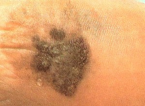 acral lentiginous melanoma pictures