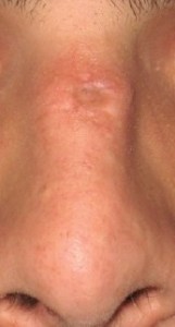 nose cyst