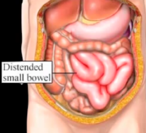 partial bowel obstruction