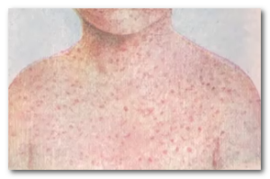 rubella rash images