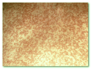 rubella rash photos