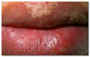 fordcye spots on lips pictures