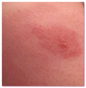 horsefly bite pictures 2