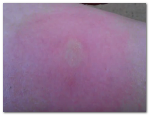 horsefly bite pictures