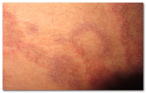 inner thigh rash pictures