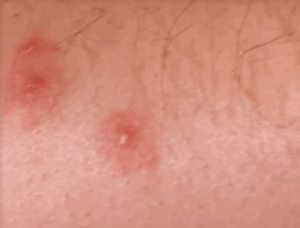 bed bug bite marks images