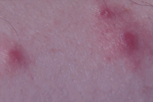 bed bug bite pictures 2