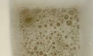 foamy urine pictures