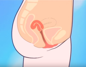 Retroverted Uterus picture