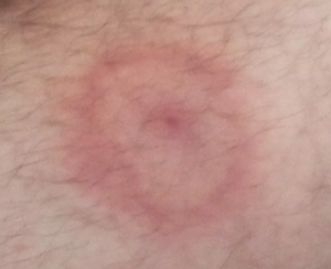lyme disease bullseye rash pictures